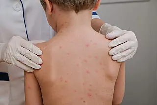 Prefeitura de São Paulo confirma morte de criança por meningite