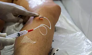 Pandemia faz cirurgias de varizes pelo SUS despencarem 69% no País
